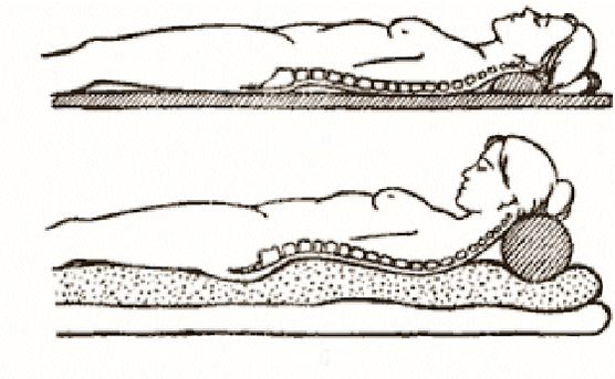 Figura osteochondrozy