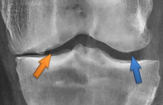 Kinezeterapia artrozy